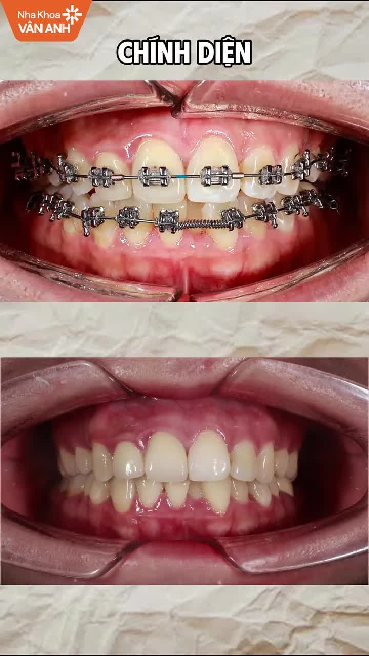 Tình trạng: Răng khấp khểnh hai hàm, sai khớp cắn.