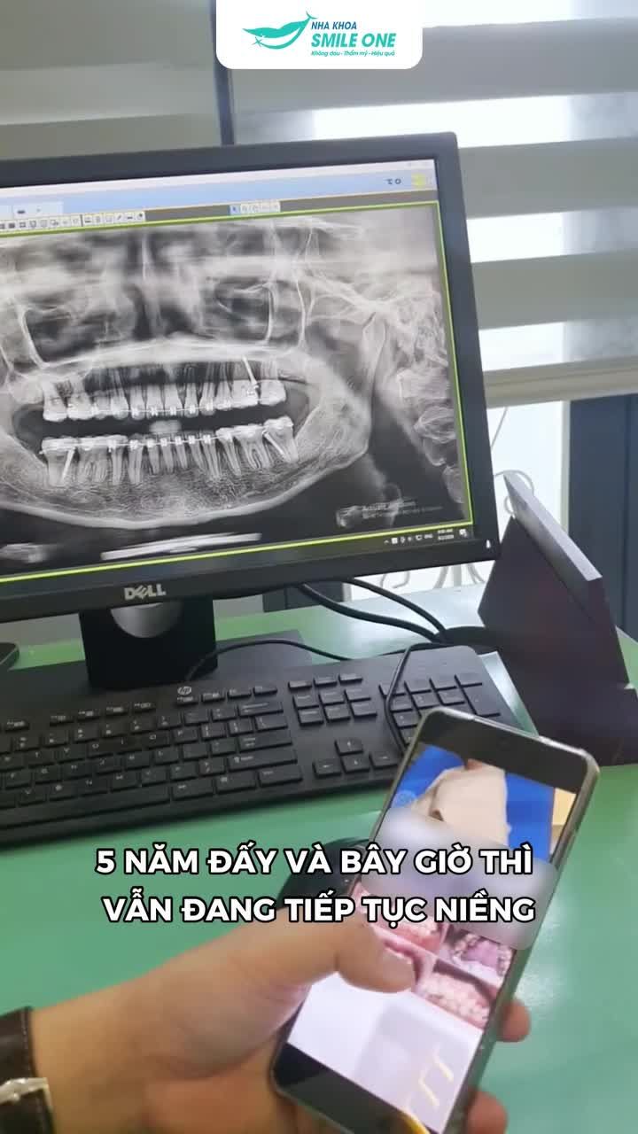 5 NĂM NIỀNG RĂNG TẠI SÀI GÒN, RA HÀ NỘI SINH SỐNG – NGỌC DỄ TIẾP TỤC HÀNH TRÌNH TẠI SMILE ONE