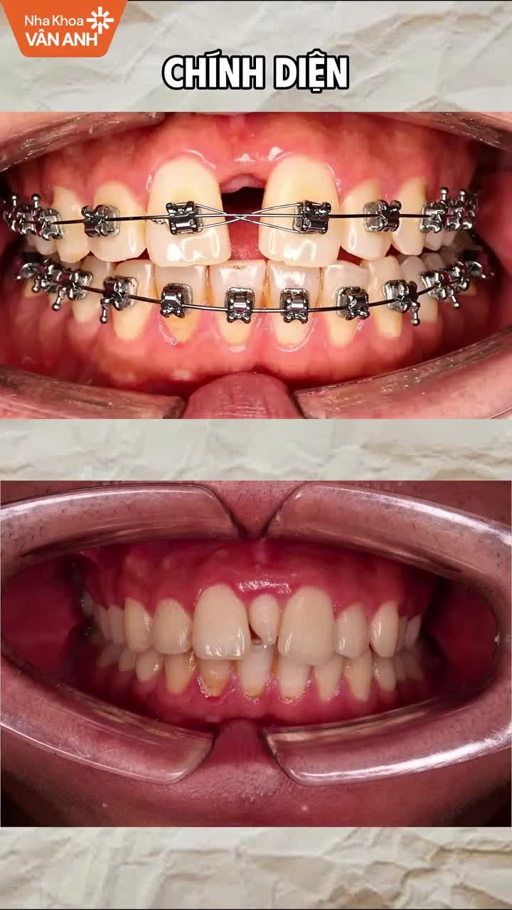 Tình trạng: Cắn sâu, sai khớp cắn, lệch mặt phẳng cắn và lệch hàm dưới.