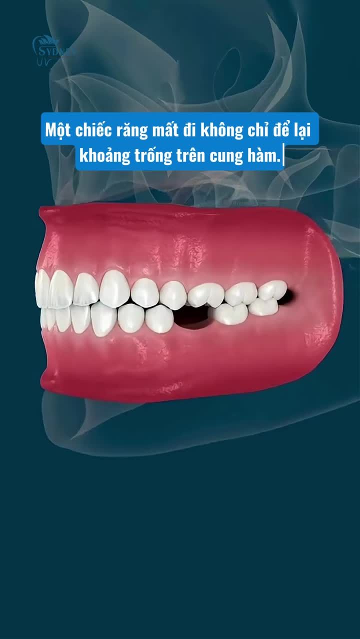 SAU KHI MẤT RĂNG: Xương hàm thay đổi như thế nào?
