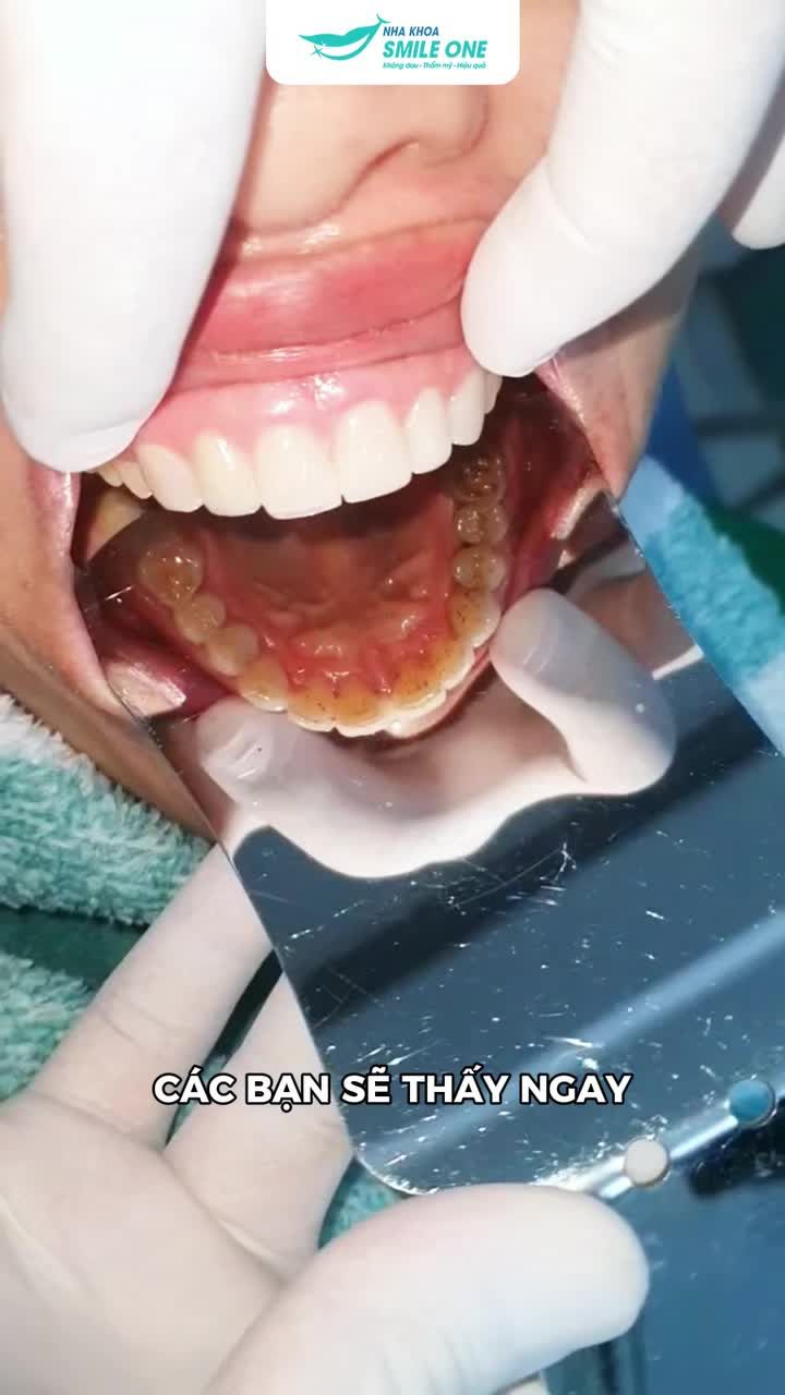 SAU 9 NĂM, KHÁCH HÀNG TRỊNH NHI QUAY LẠI SMILE ONE VÌ… 1 MIẾNG DÁN SỨ BỊ BUNG
