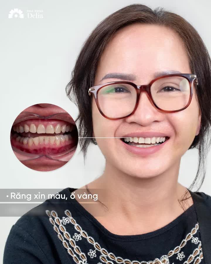"Làm răng sứ tại Delia là quyết định đúng đắn của chị"