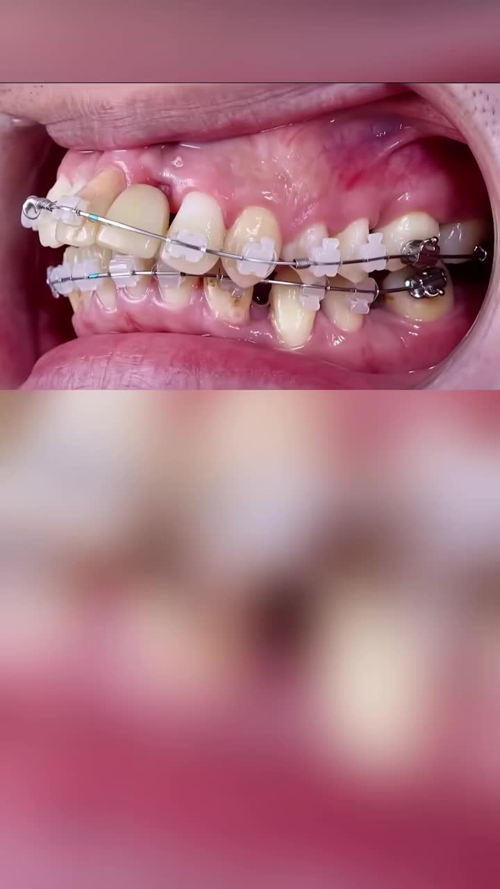 Có lỡ bọc sứ do sâu vỡ từ nhỏ thì niềng cũng không vấn để gì các bạn nhé