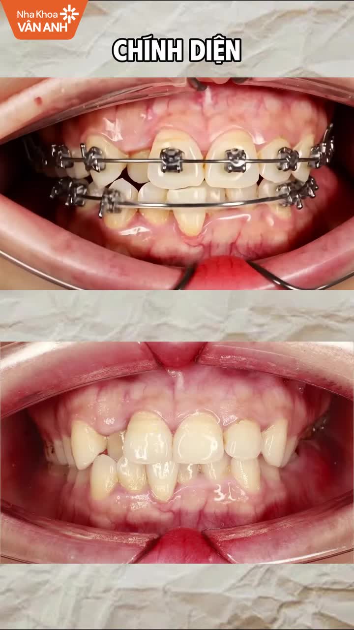 Tình trạng: Răng khấp khểnh hai hàm, mất răng 36, lệch đường giữa, sai khớp cắn.
