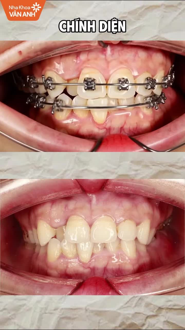 Tình trạng: Răng khấp khểnh hai hàm, mất răng 36, lệch đường giữa, sai khớp cắn.