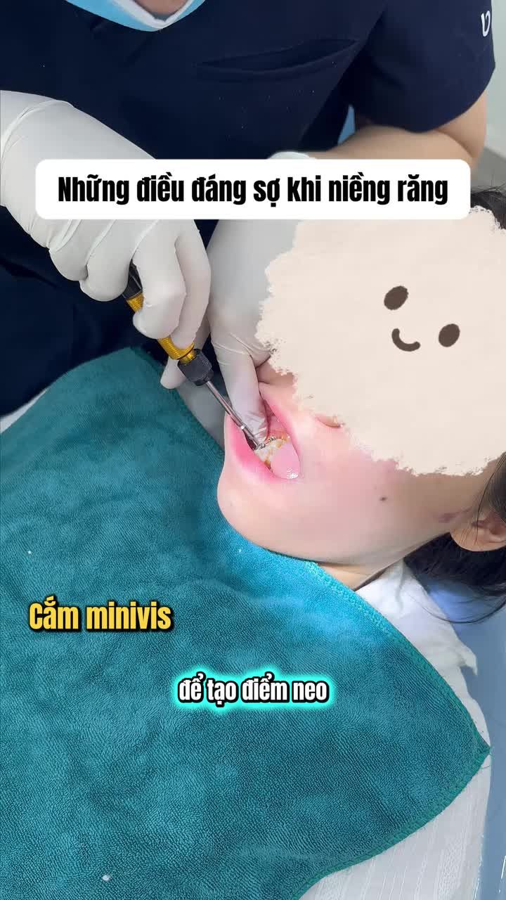 Điểm danh các nỗi đáng sợ khi niềng răng mà chị để ý !