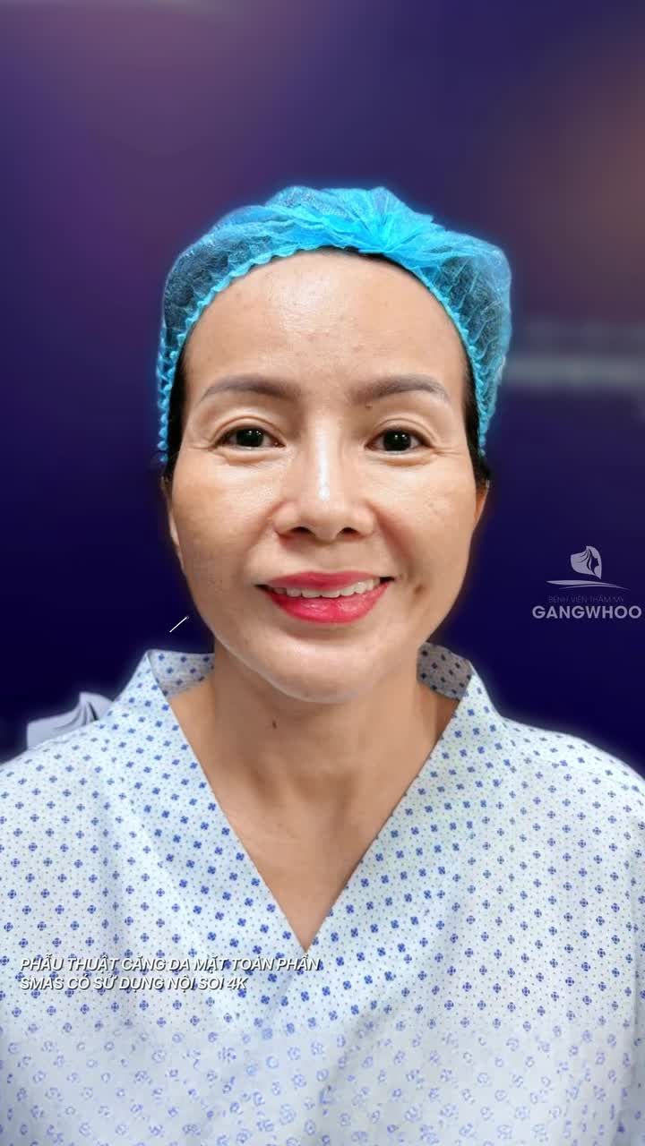 "Nếu biết trẻ như vậy sẽ làm sớm hơn" - đó là chia sẻ của chị khách sau 10 ngày thực hiện căng da mặt toàn phần Smas có sử dụng nội soi 4K tại Bệnh viện thẩm mỹ Gangwhoo