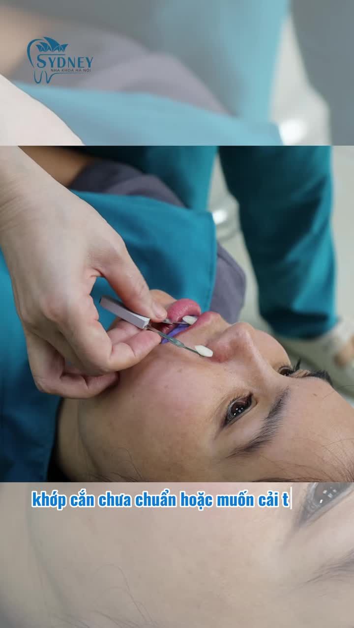 Răng đã bọc sứ có niềng răng được không?