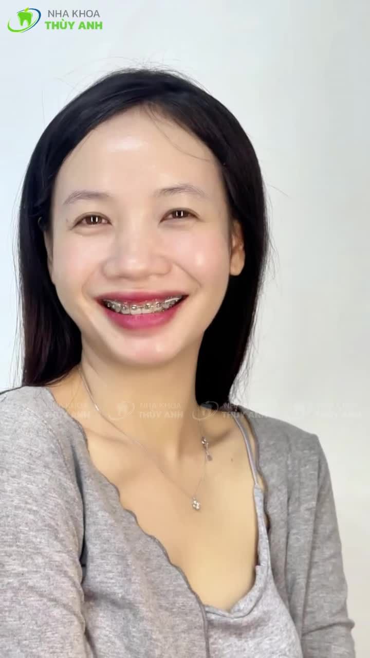 COMBO HÔ - CƯỜI HỞ LỢI: NIỀNG RĂNG XỬ LÝ GỌN CHO BẠN NỤ CƯỜI RẠNG RỠ