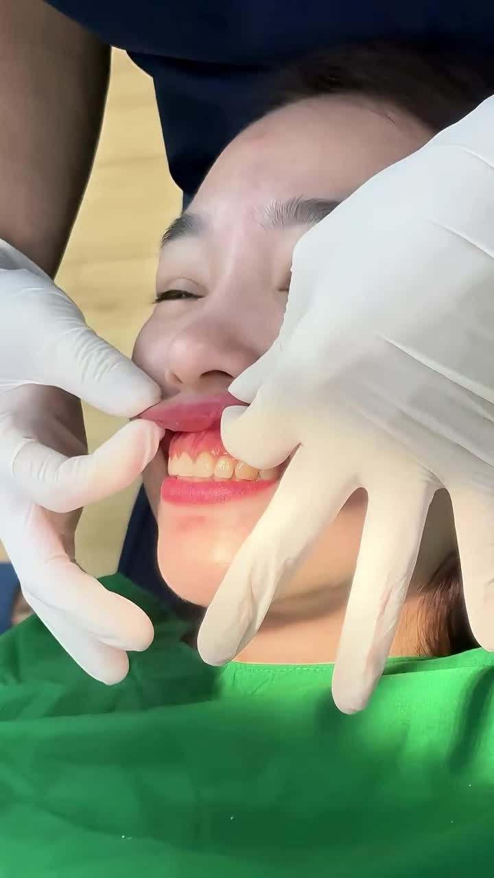Xem thêm 173 video Điều Trị Cười Hở Lợi của bác sĩ Bs nha khoa Thùy Anh