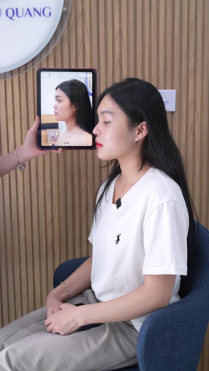 Mũi nâng nhưng vẫn khẳng định là mũi thật ạ, kết quả sau 6 tháng của chiếc mũi sụn sườn rất chi là tự nhiên cho bạn gái Lạng Sơn