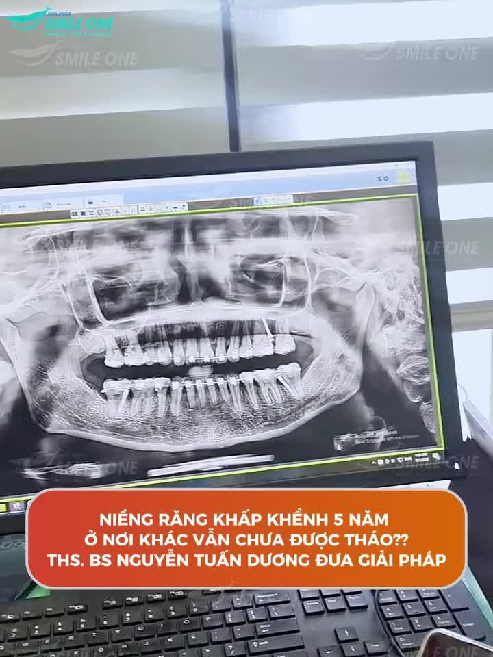 5 NĂM NIỀNG RĂNG VẪN CHƯA ĐƯỢC THÁO?