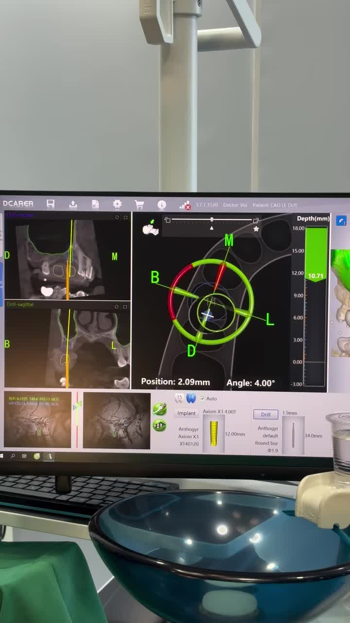 Bạn sợ trồng Implant vì lo bác sĩ "cắm sai chỗ"?