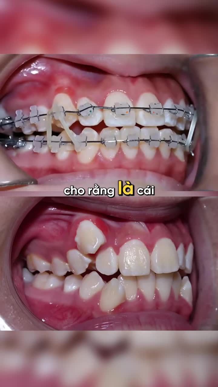 RĂNG KHỂNH CÓ PHẢI NIỀNG KHÔNG?