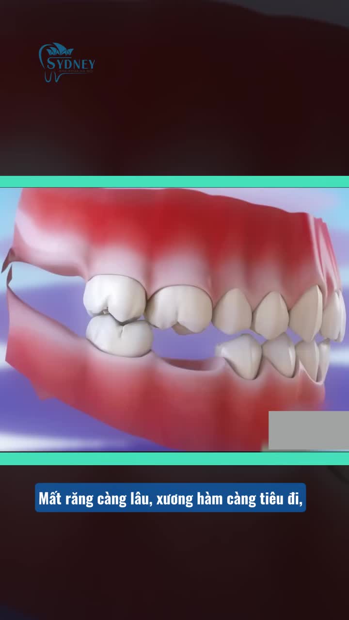 CHẤM DỨT THÁNG NGÀY ĂN NHAI KHÓ KHĂN NHỜ TRỒNG RĂNG IMPLANT