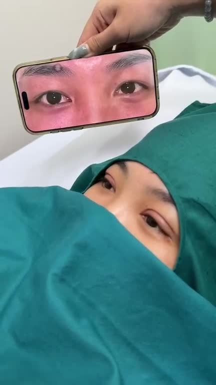 Tạm biệt mí lót kém sắc, 9X Lâm Đồng sở hữu ĐÔI MẮT LONG LANH, CUỐN HÚT sau 7 ngày CẮT MẮT tại JW