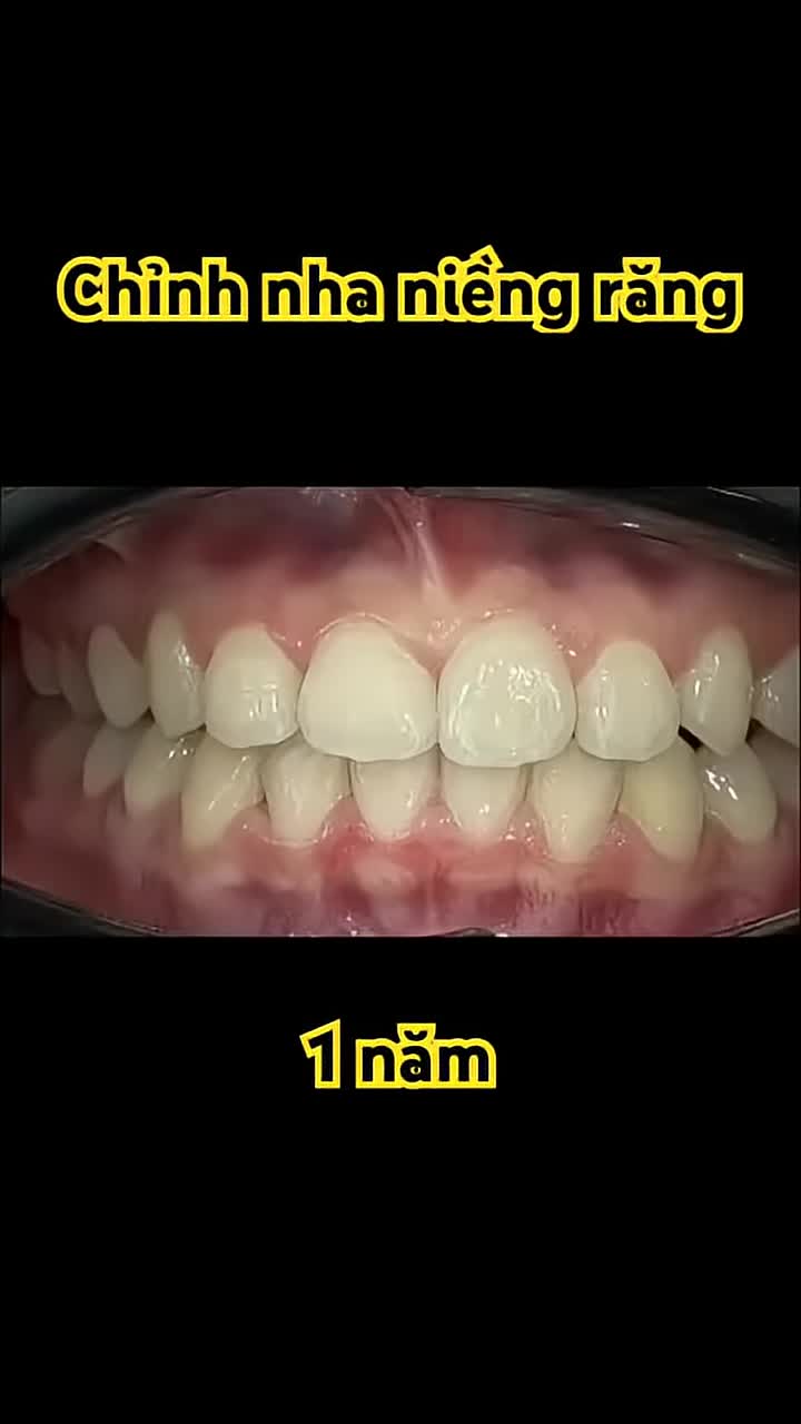 Chỉnh nha sau 1 năm