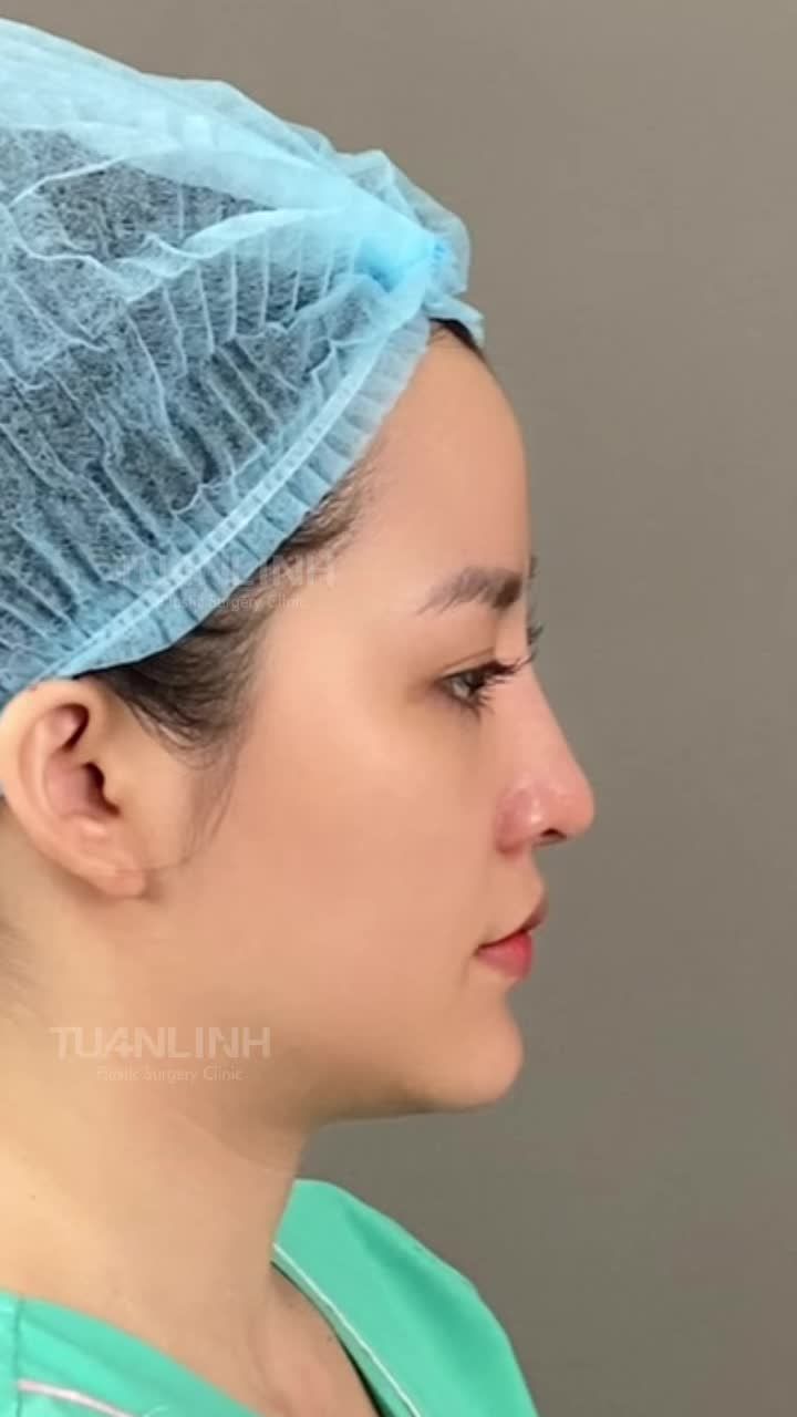 NÂNG MŨI CẤU TRÚC KẾT HỢP CHỈNH XƯƠNG BÈ - THAY ĐỔI NHỎ CHO HIỆU QUẢ THẨM MỸ ĐỈNH CAO