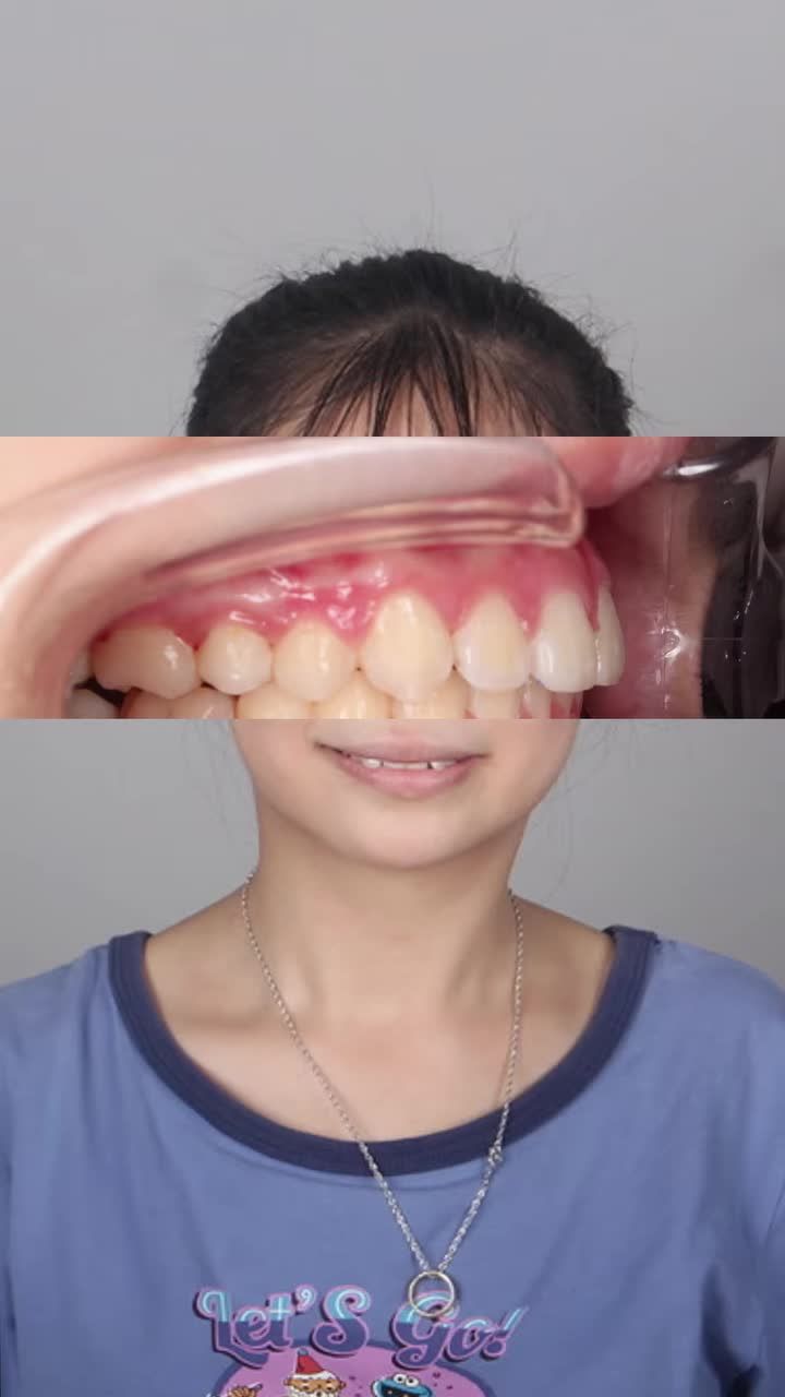Tình trạng: Hai hàm khấp khểnh nhẹ, cung răng hẹp, răng cửa trên chìa, cắn sâu, khớp cắn hạng II, môi nhô nhẹ và cằm lùi.