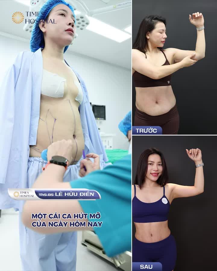 CASE TẠO HÌNH ĐA VÙNG - HƯỚNG TỚI ĐƯỜNG CONG CHỮ S MỀM MẠI