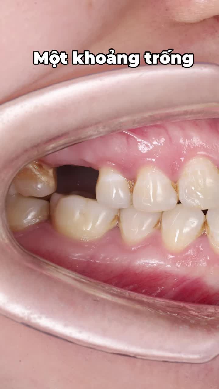 MẤT RĂNG SỐ 6 – ĐẰNG SAU MỘT KHOẢNG TRỐNG LÀ CẢ MỘT CHUỖI HỆ LỤY