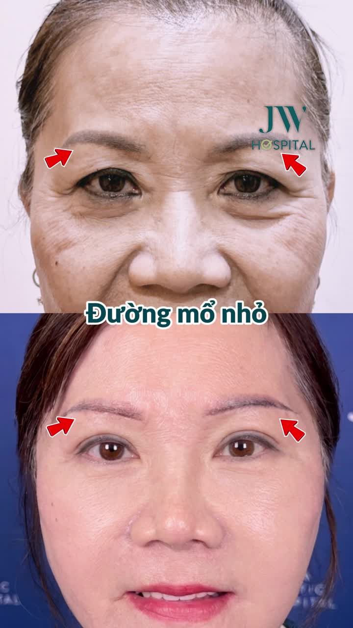 CẮT DA, CĂNG CHỈ U70 MIỀN TÂY XÓA GIÀ 20 TUỔI, SẸO VÔ HÌNH SAU COMBO CẢI LÃO TẠI JW