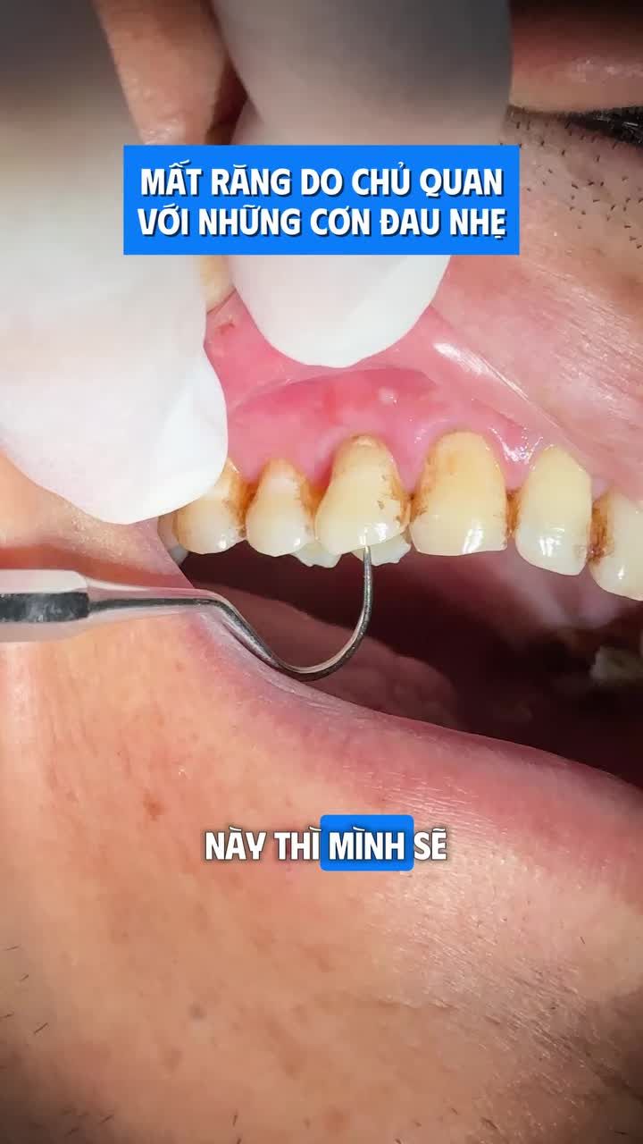 MẤT RĂNG DO CHỦ QUAN VỚI NHỮNG CƠN ĐAU NHẸ
