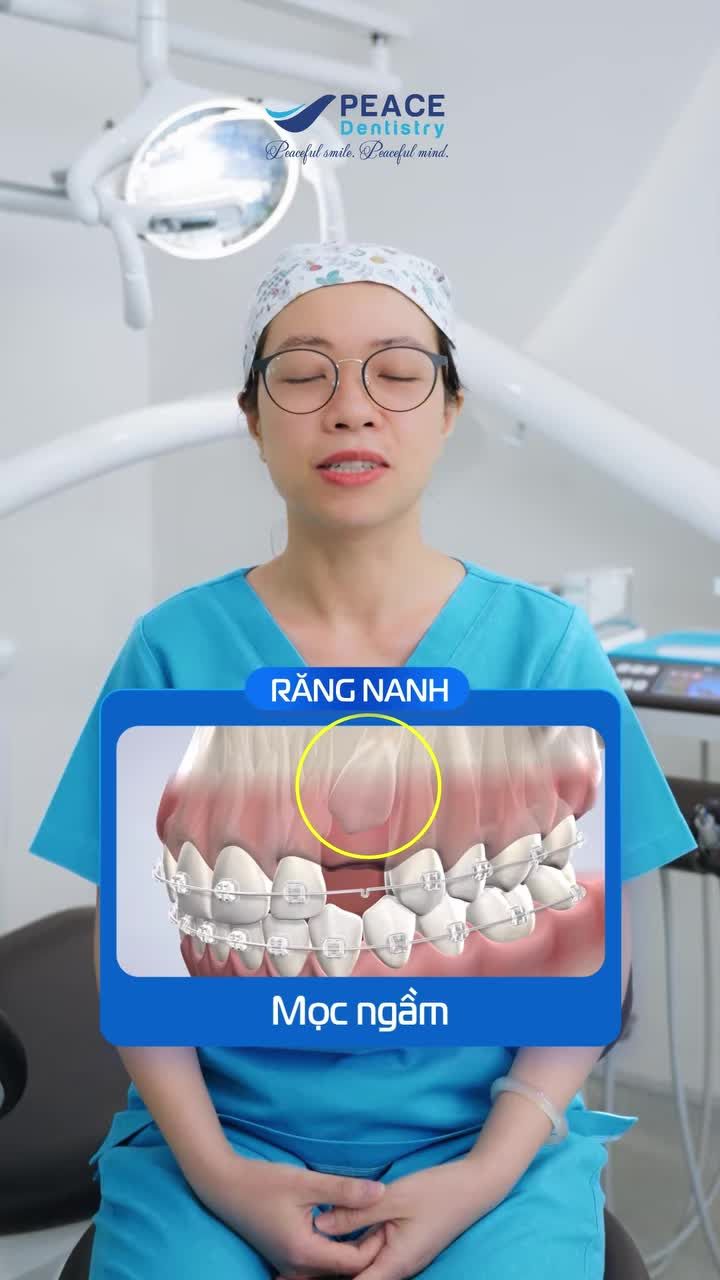 Răng khôn mọc ngầm có thể gây đau nhức, viêm nhiễm và ảnh hưởng đến răng bên cạnh nếu không xử lý kịp thời
