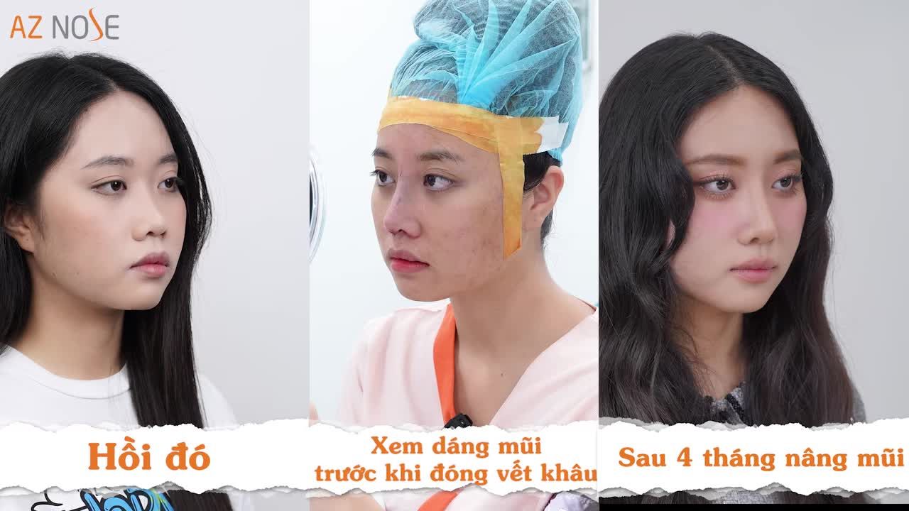 Sinh viên 2K7 - em gái của Top 35 HHVN Phương Thảo lựa chọn "nâng mũi" để tự tin và nổi bật hơn khi bước vào Đại học.