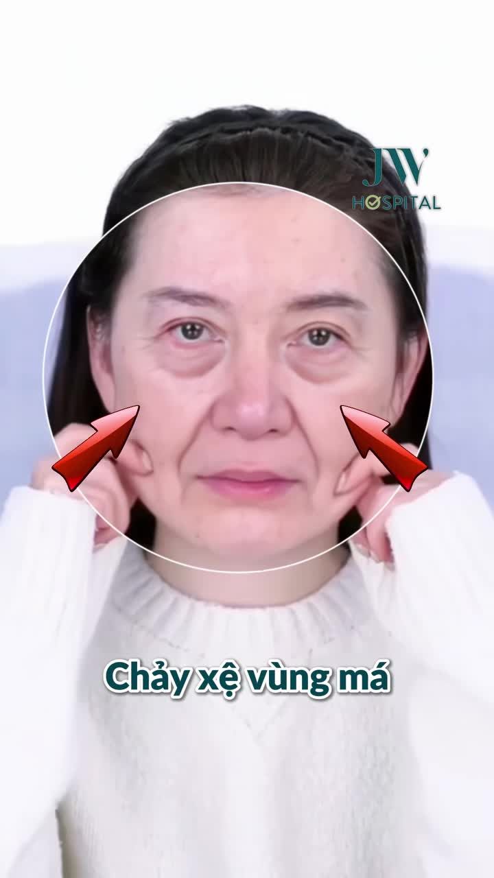 CHỊ EM TP.HCM 50-80 TUỔI LÃO HOÁ NGƯỢC 20 NĂM VỚI CĂNG DA MẶT SMAS PRO KHÔNG ĐƠ CỨNG, SẸO VÔ HÌNH TẠI JW