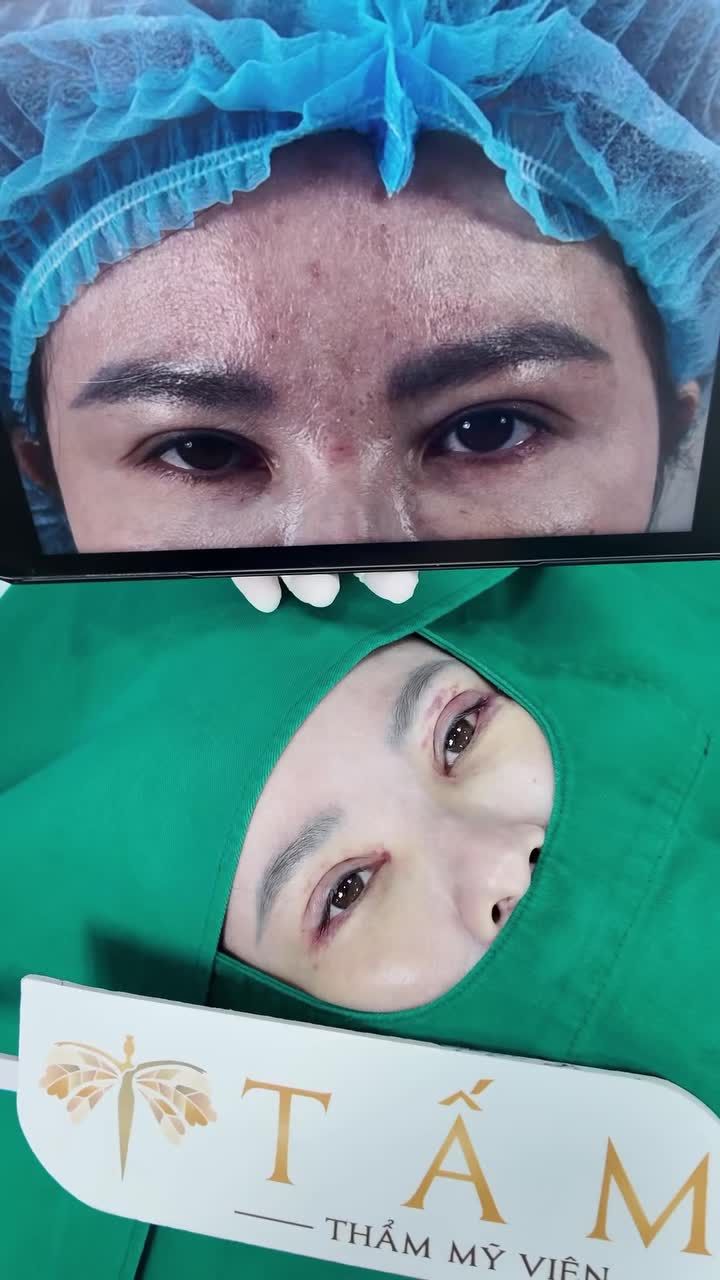 Giải cứu đôi mắt cắt mí bị hỏng cho khách hàng