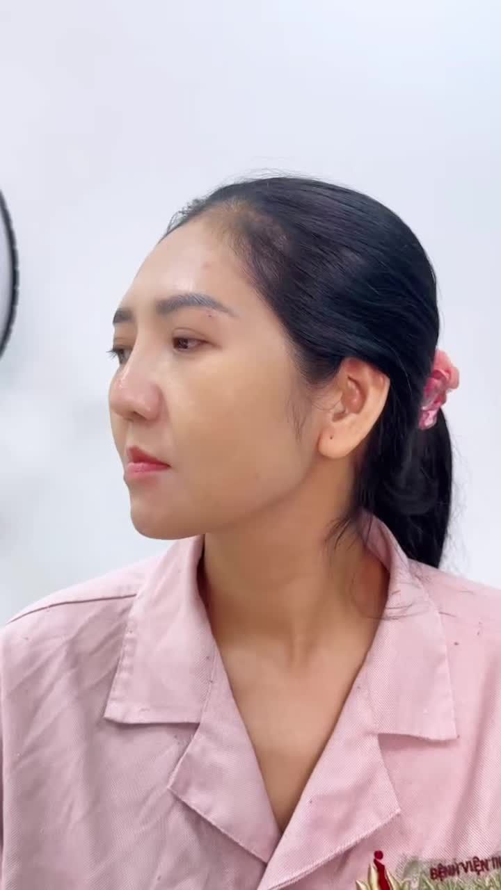 “LÀM MỚI” DÁNG MŨI SỤN SƯỜN VỚI SURGIFORM SAU 10 NGÀY