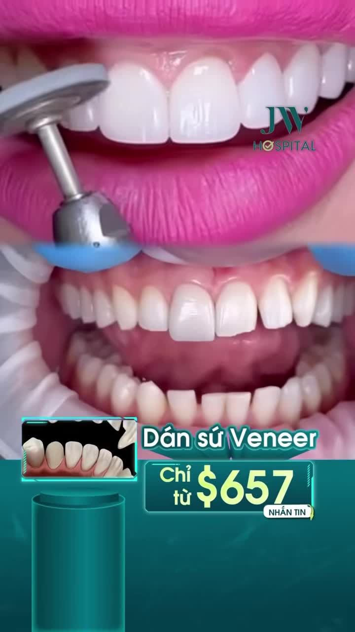 VIỆT KIỀU MỸ RĂNG XẤU NÊN CHỌN BỌC SỨ HAY DÁN SỨ VENEER - BÁC SĨ TÚ DUNG CHỈ ĐIỂM GIẢI PHÁP ĐÚNG