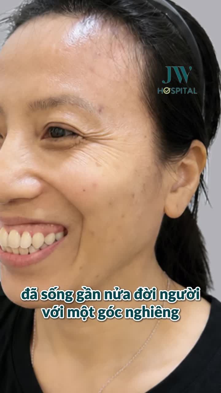 PHẪU THUẬT HÀM HÔ Ở TUỔI 50 CÓ NGUY HIỂM KHÔNG? CHỊ KHÁCH NHẬN KẾT QUẢ SỐC TẠI JW