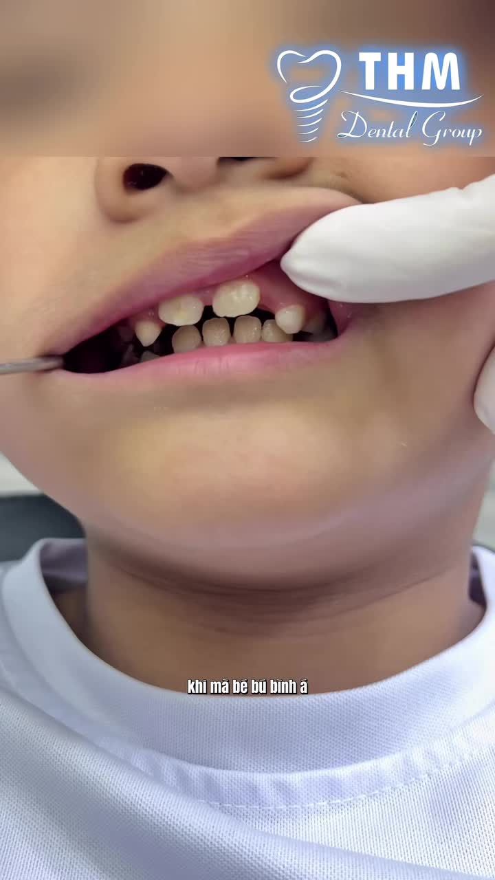 BÚ BÌNH KÉO DÀI – KHÔNG CHỈ ẢNH HƯỞNG ĐẾN RĂNG MÀ CÒN CÓ THỂ ẢNH HƯỞNG ĐẾN SỰ PHÁT TRIỂN CỦA HÀM