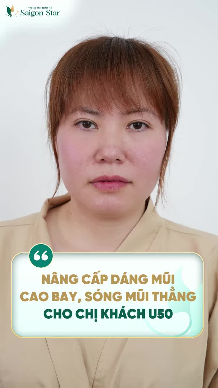 THÀNH CÔNG NÂNG CẤP DÁNG MŨI CHO CHỊ KHÁCH U50