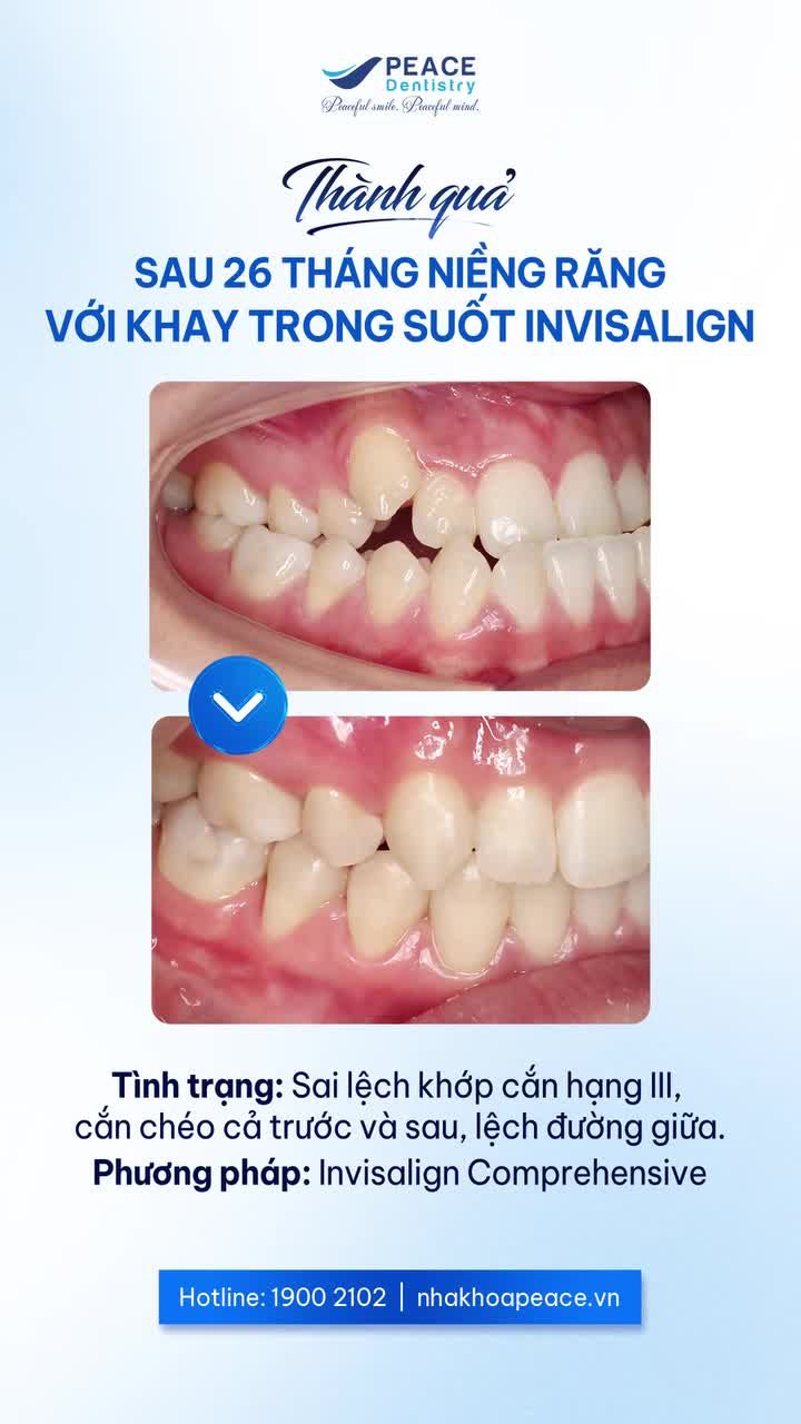 NÂNG CẤP NỤ CƯỜI TỰ TIN & RẠNG RỠ HƠN VỚI NIỀNG RĂNG INVISALIGN