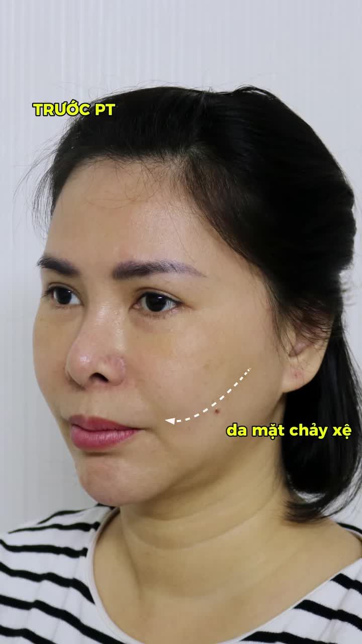 LẤY LẠI 10 TUỔI XUÂN – HIỆU QUẢ VỮNG BỀN THEO THỜI GIAN