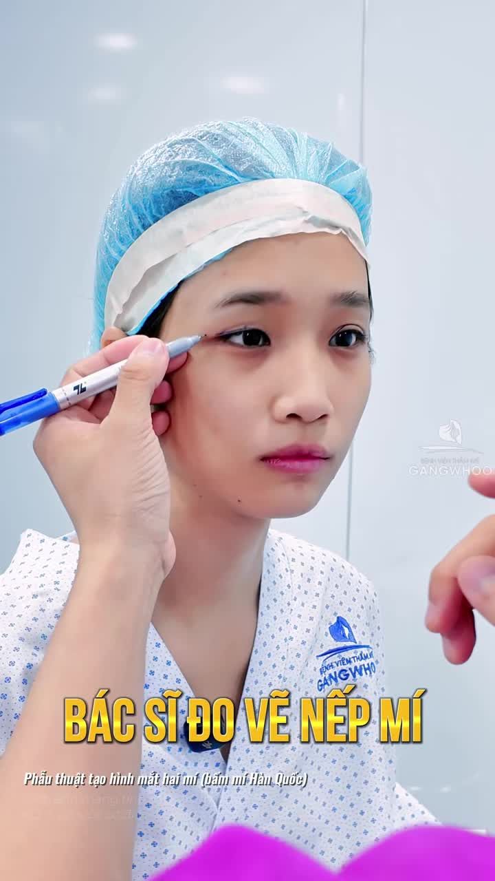 Bấm mí Hàn Quốc sở hữu ngay nếp mí to, tròn, đều, tự nhiên