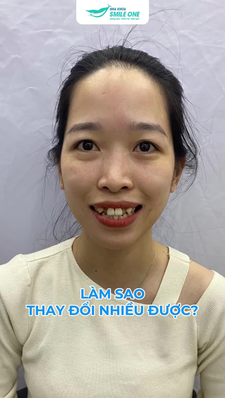 NIỀNG RĂNG HAY LÀ "THAY ĐẦU" VẬY Ạ?