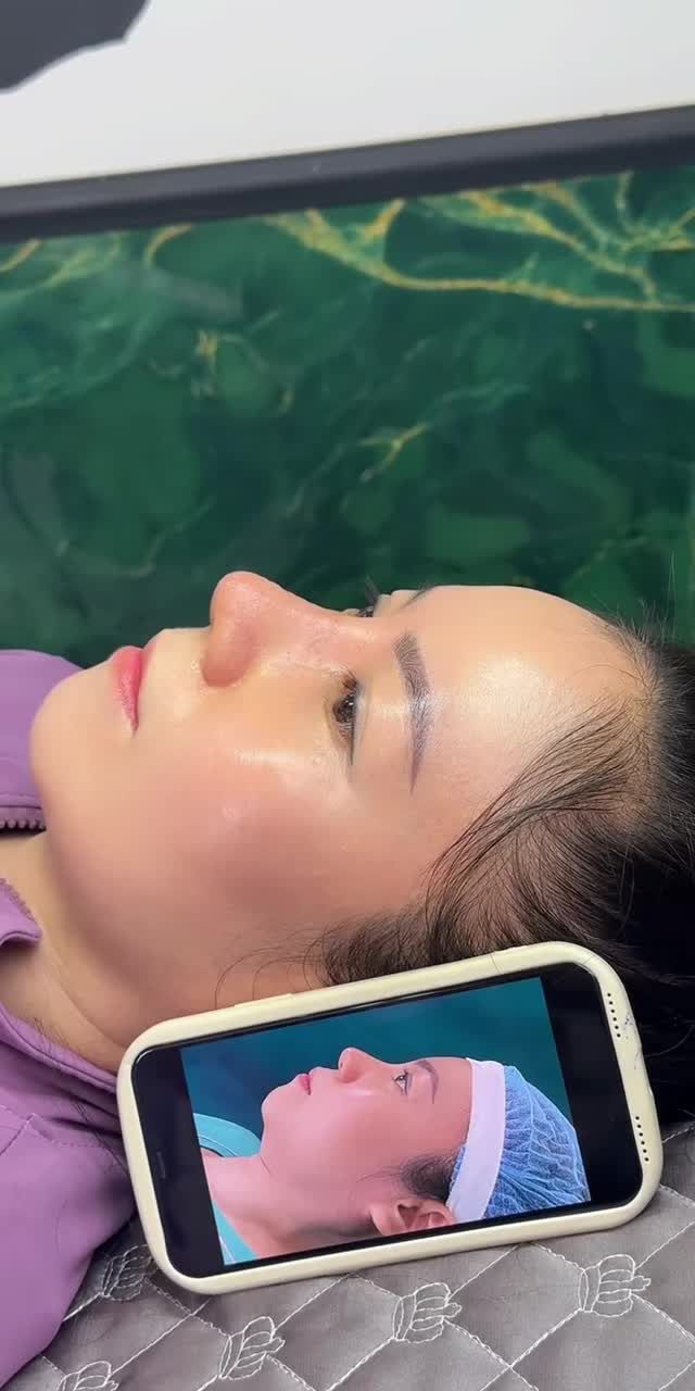 THÁO NẸP MŨI 10 NGÀY - NGỠ TRẺ RA 10 TUỔI