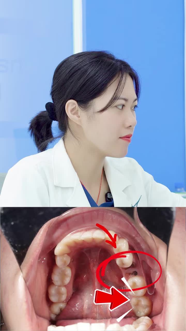 Mất răng trong thời gian dài nên niềng hay cắm implant