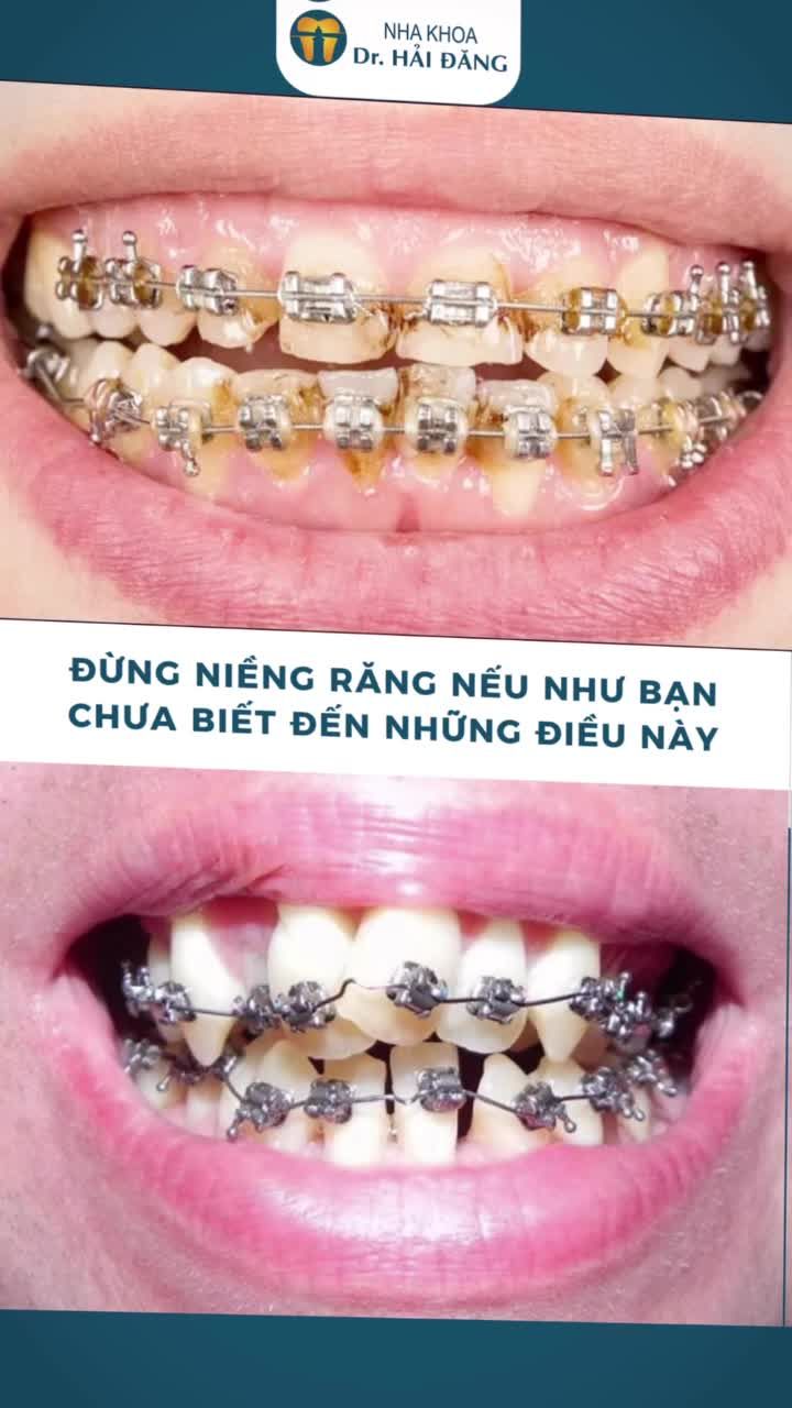 ĐỊNH NIỀNG RĂNG? KHOAN! XEM CÁI NÀY ĐÃ