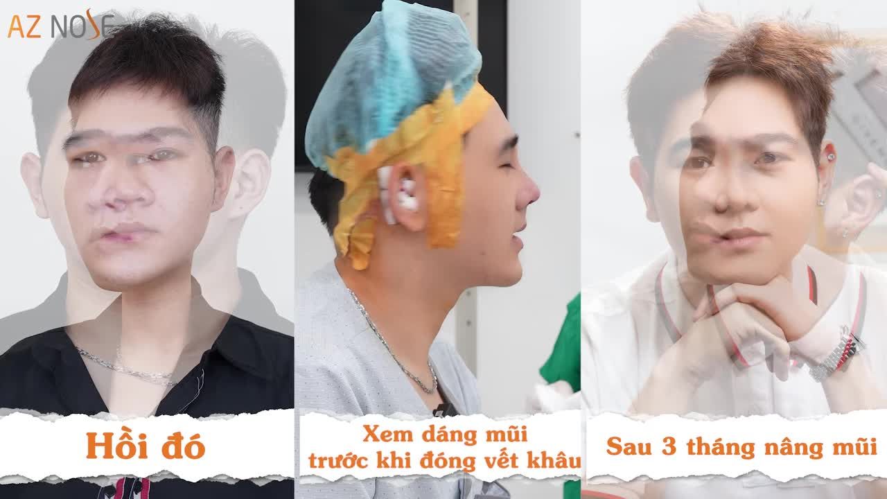 Dáng mũi mới giúp  sinh viên 2k5 sở hữu gương mặt ưa nhìn, đường nét cân đối và "tươi sáng" hơn hẳn