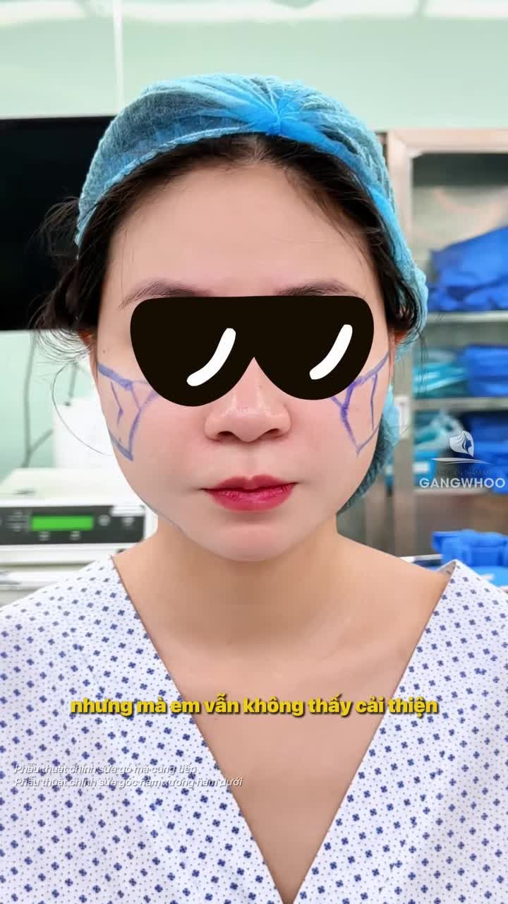 Tại sao nên gọt hàm – hạ gò má trước rồi mới căng da mặt?