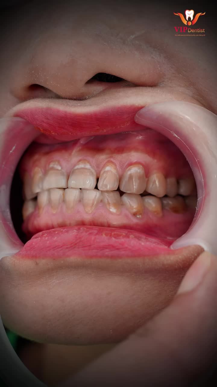 HÔ BIẾN HÀM RĂNG XỈN MÀU THÀNH TRẮNG SÁNG!