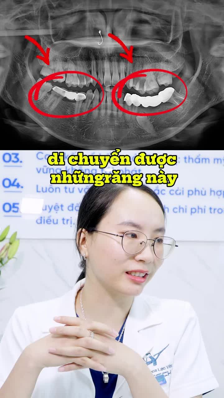 Đã bọc sứ có niềng răng được không