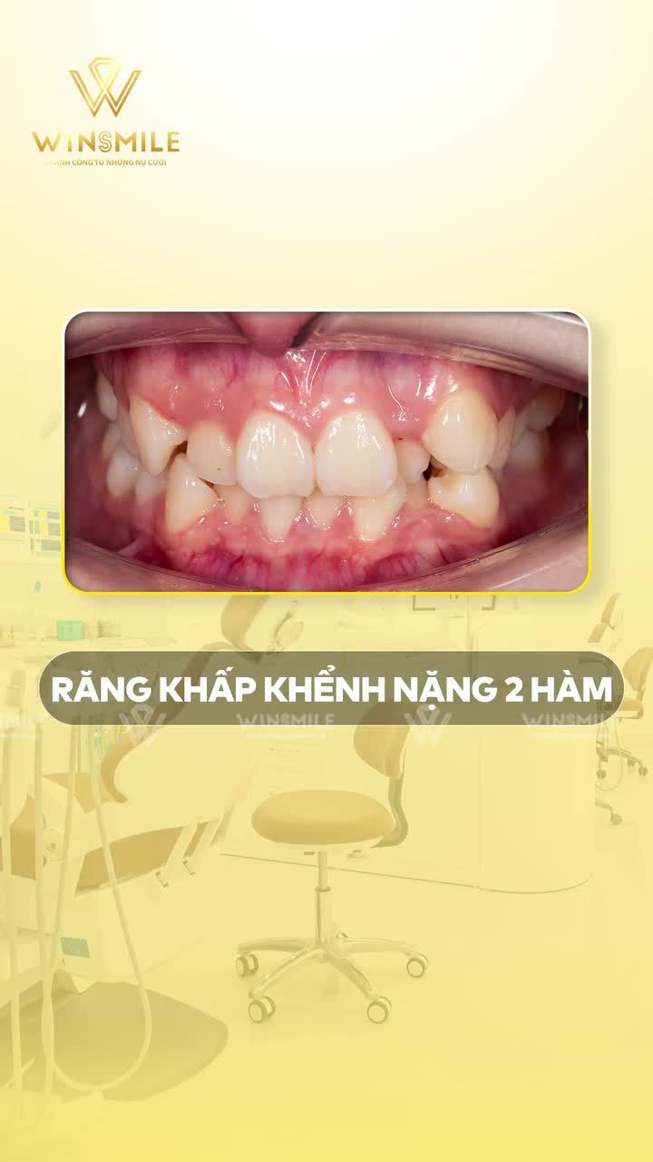 12 tháng niềng Invisalign: Từ răng khấp khểnh nặng đến nụ cười cân đối tuổi 21