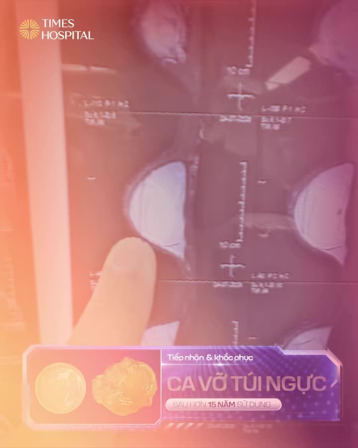 VỠ TÚI NGỰC SAU HƠN 15 NĂM SỬ DỤNG  "Khi phát hiện ra, em rất lo lắng, thậm chí là rất hoang mang..."