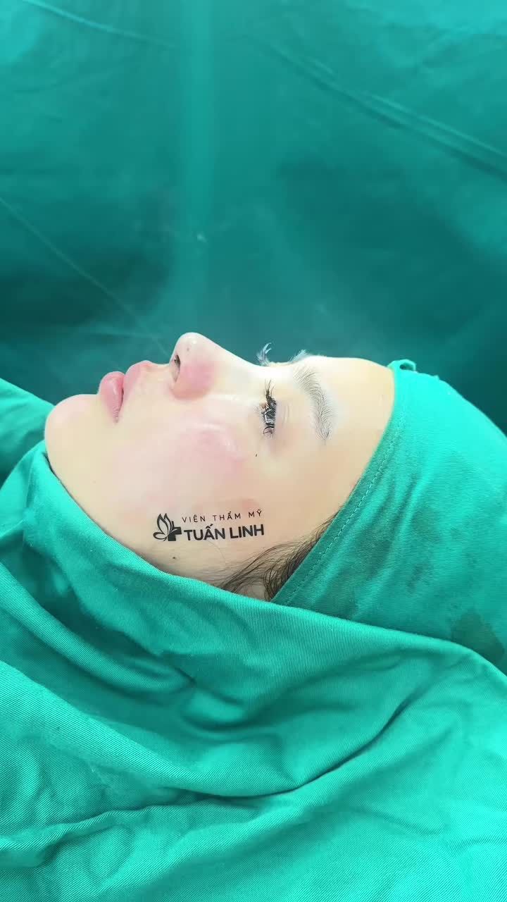 Case mũi cấu trúc bioform vừa hoàn thành